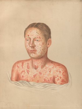 Severely diseased skin on the face, buttocks and genitals of a baby boy suffering from inherited syphilis. Chromolithograph by E. Burgess, 1850/1880?.