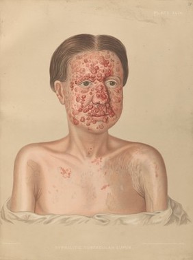 Areas of diseased skin on the scalp of a child affected by kerion from ringworm. Chromolithograph by E. Burgess, 1850/1880?.