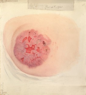 Areas of diseased skin on the scalp of a child affected by kerion from ringworm. Chromolithograph by E. Burgess, 1850/1880?.