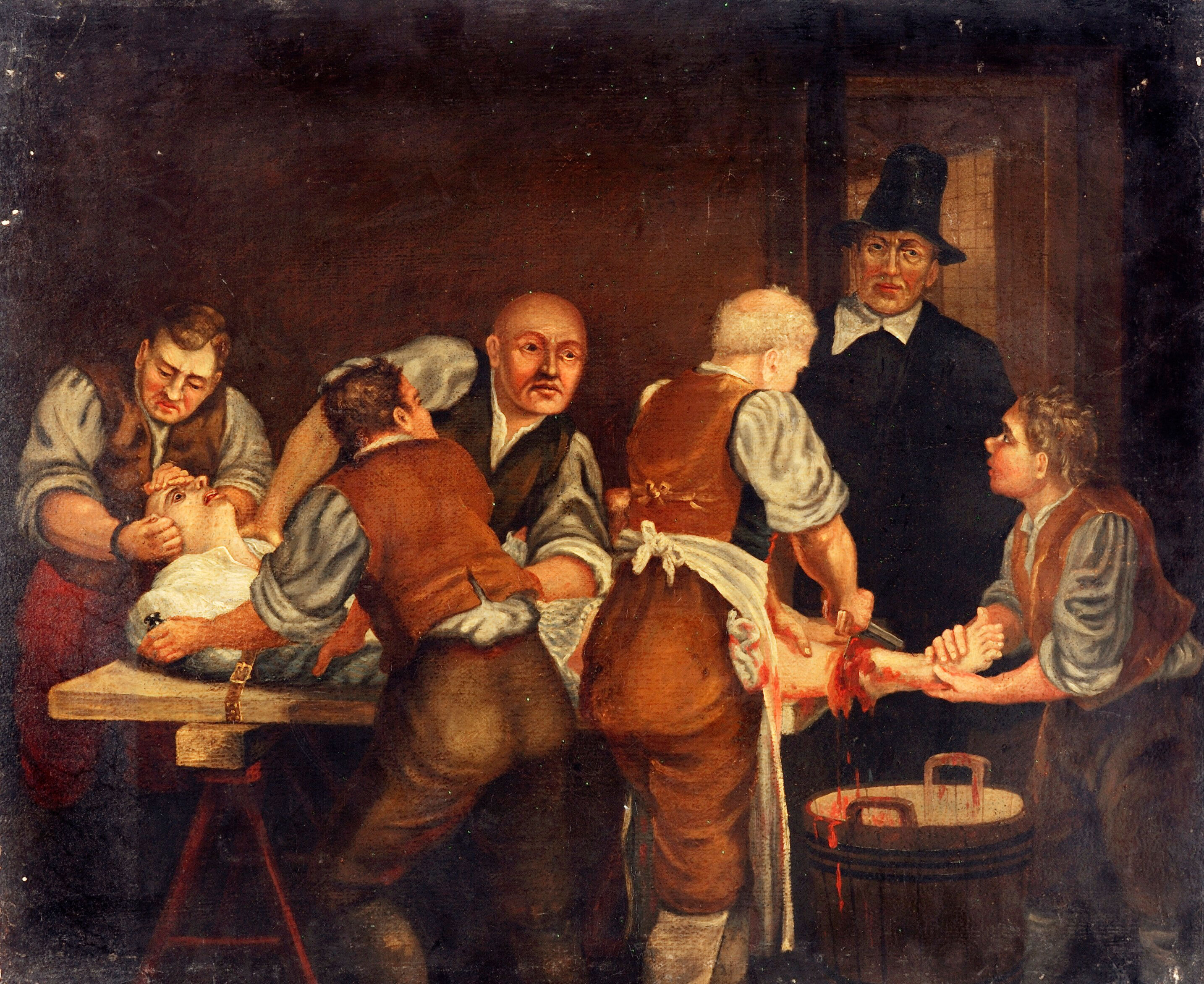 A surgeon performing an amputation of the leg in the seventeenth ...