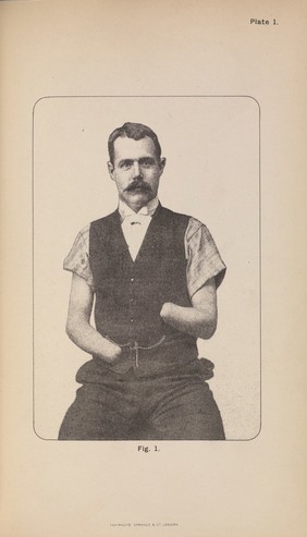 On the application of suitable mechamism to a case of amputation of both hands / by F. Gustav Ernst.
