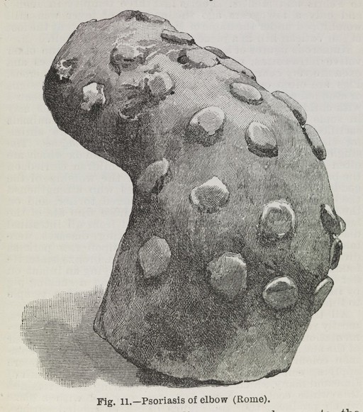 Fig. 11. - Psoriasis of elbow (Rome).
