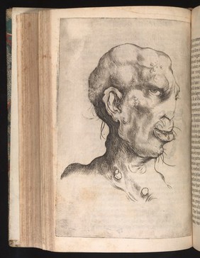Head illustrating syptoms of syphilis. Engraving, 1632.