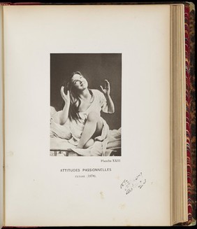 Iconographie photographique de la Salpêtrière : service de M. Charcot / par Bourneville et P. Regnard.