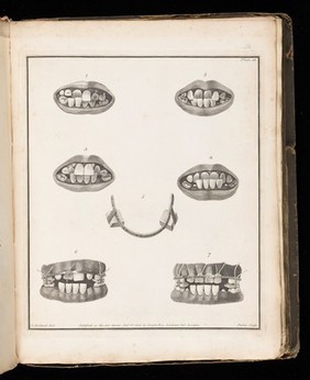 Plate 12. Irregularly aligned teeth