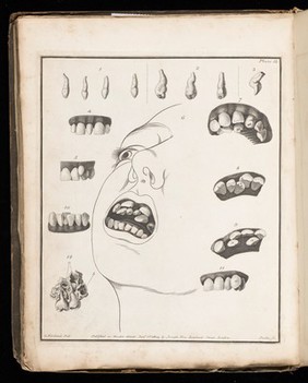 Plate 13, Cases of supernumerary teeth