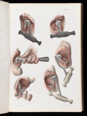 Tav. 24. Tooth extraction