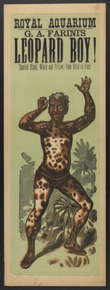 A black boy with white skin-markings (leukoderma), advertised for exhibition. Colour line block.