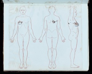 view Post mortem report on herpes zoster patient. From the records of Sir Henry Head (1861-1940).