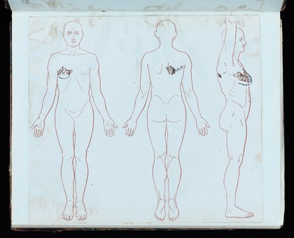 Post mortem report on herpes zoster patient. From the records of Sir Henry Head (1861-1940).