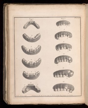 Plate 11. Examples of permanent teeth with irregular growth.