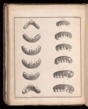 view Plate 11. Examples of permanent teeth with irregular growth.