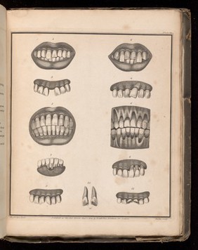 Plate III. Teeth affected by absorption, disease and trauma