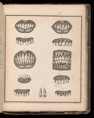 view Plate III. Teeth affected by absorption, disease and trauma