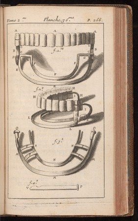 Artificial teeth with.springs. P. Fauchard, 1728.