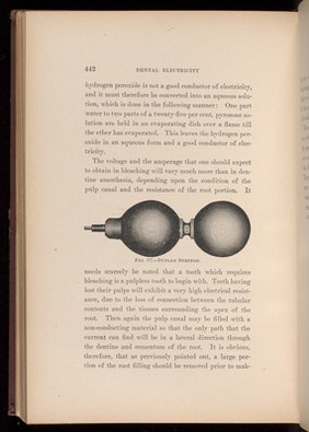 Duplex Syringe.Fig. 177, page 442, 'Dental Electricity' by Levitt E Custer, 1901.
