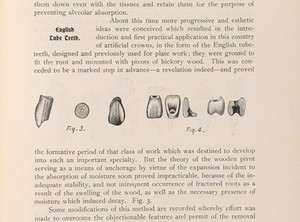 view "English tube-teeth". The introduction of artificial crowns in England. Those made with wood decayed by moisture (Fig. 3). The screw-pivot used in the patented Foster crown (1885) had a flat base with a perforation in the porcelain body to accommodate the pivot's top, which securely anchored it to a tooth. (Fig 4).