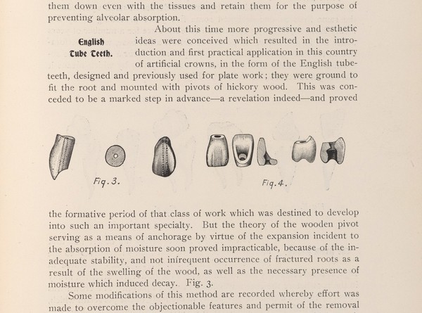 "English tube-teeth". The introduction of artificial crowns in England. Those made with wood decayed by moisture (Fig. 3). The screw-pivot used in the patented Foster crown (1885) had a flat base with a perforation in the porcelain body to accommodate the pivot's top, which securely anchored it to a tooth. (Fig 4).