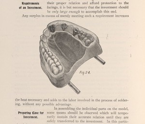 view Model with crowns in a dental articulator