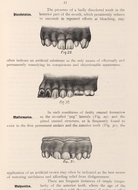 Malformed teeth examples.