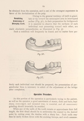 Teeth in preparation for bridgework.