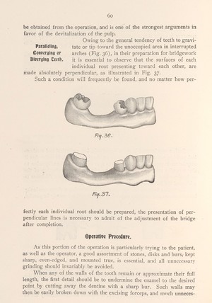 view Teeth in preparation for bridgework.