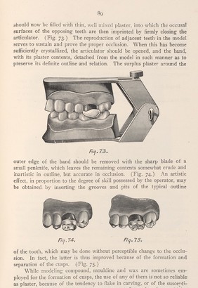 The making of a gold shell or a telescope crown. By using models mounted on an articulator an impression can be taken of the biting surface of the opposing teeth. Fig 73.
