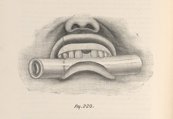 Patient biting on a roll of cotton