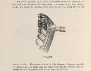 view Crown fitted to a tooth with the use of a twisted wire