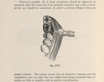 Crown fitted to a tooth with the use of a twisted wire