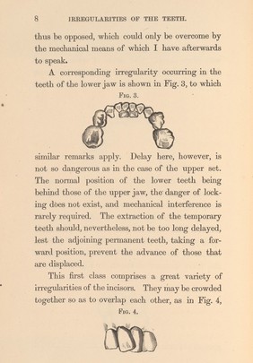 Irregular growth of teeth, p. 8.