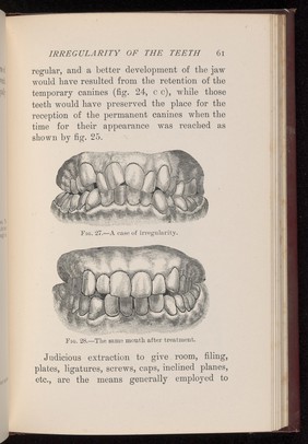 Irregularity in teeth and the same mouth after treatment.