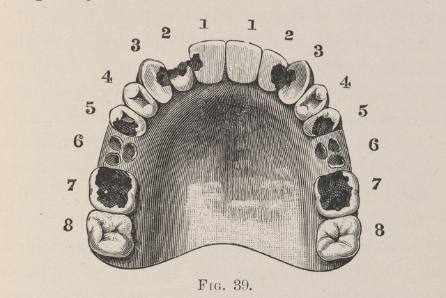 phossy jaw | Catalogue search | Wellcome Collection