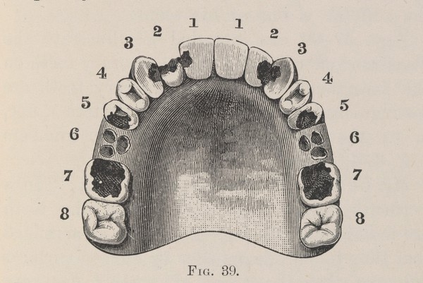 Teeth in the upper jaw of a 19 year old with severe decay.