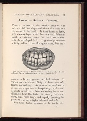 A mouth with accumulation of yellowish coloured tartar collected at the necks of the teeth. 
