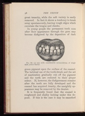 Teeth with an accumulation of rough dark yellow tartar.