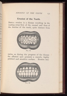 Erosion of the enamel of the teeth.