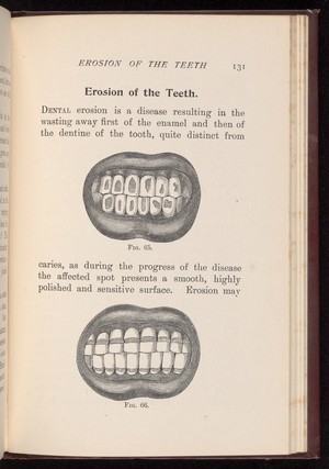 view Erosion of the enamel of the teeth.