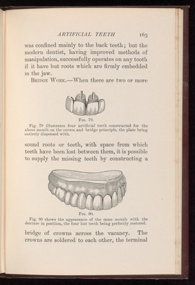 Dental bridge and denture