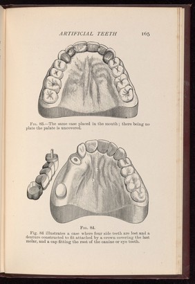 Dental bridge constructed to replace missing teeth.