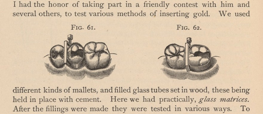 A dental matrix used to hold the tooth in place