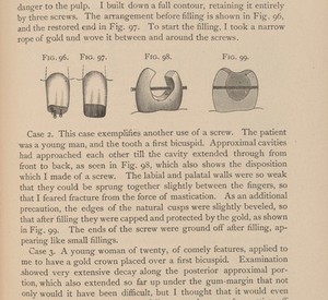 view Dental filling of the first biscuspid.