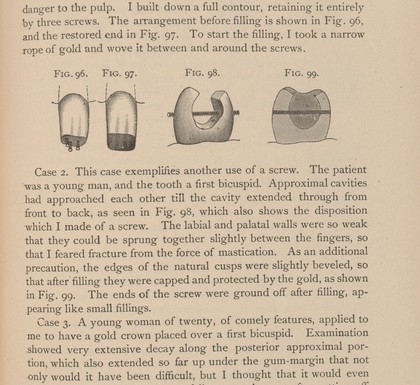 Dental filling of the first biscuspid.