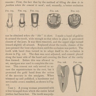 Dental filling methods. 