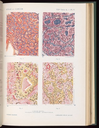 Plate V, Atlas du cancer, J. Darier, 1922-1931.
