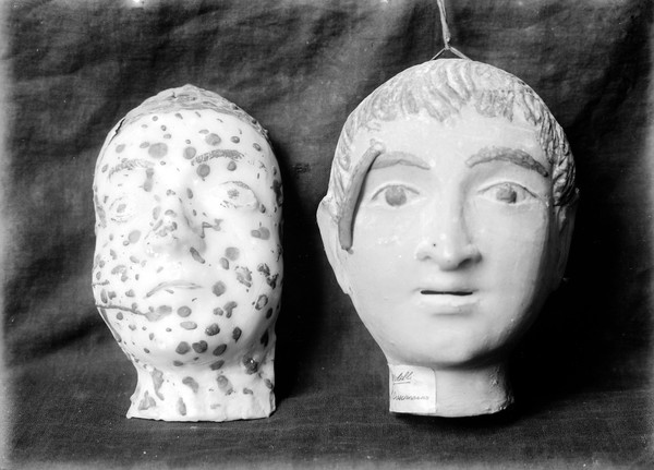 Wax ex-voto of two heads left covered with spots and right with growth over right eye. Musee Etnographique, Palermo.