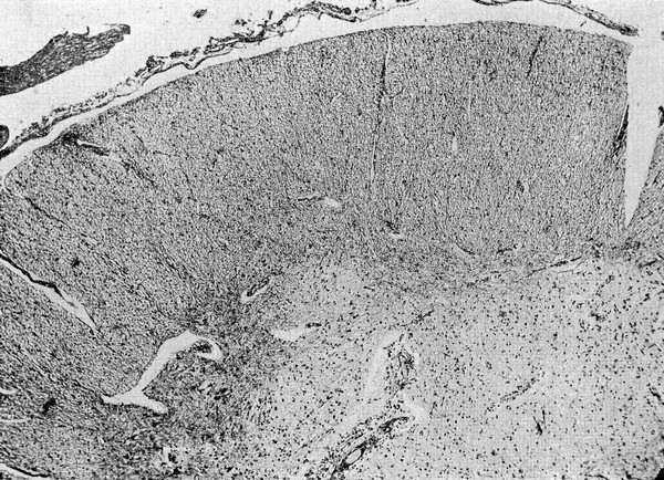 M0002832: Microscopic view of Scurvy in lumbar cord