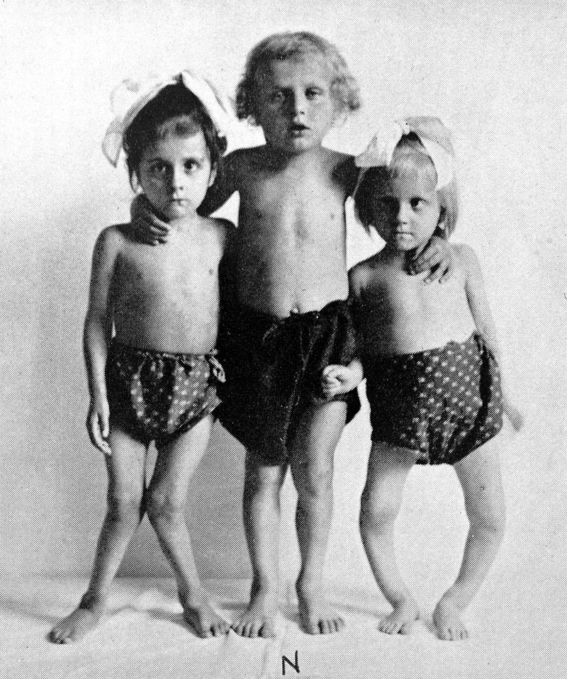 M0003399: Children showing effects of rickets on physical development ...