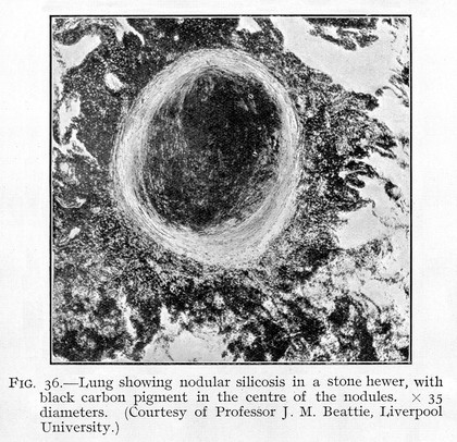 M0003416: Lung displaying symptoms of nodular silicosis