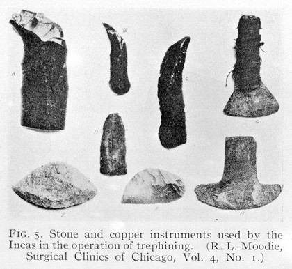 Stone and copper instruments used by the Incas in the operation of trephining